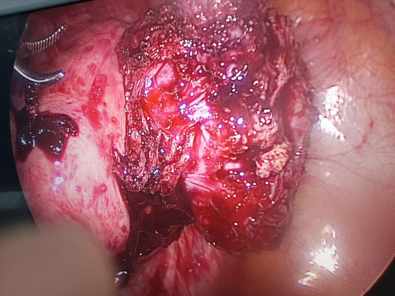 10x10 cm fibroid removed through laparoscopic myomectomy