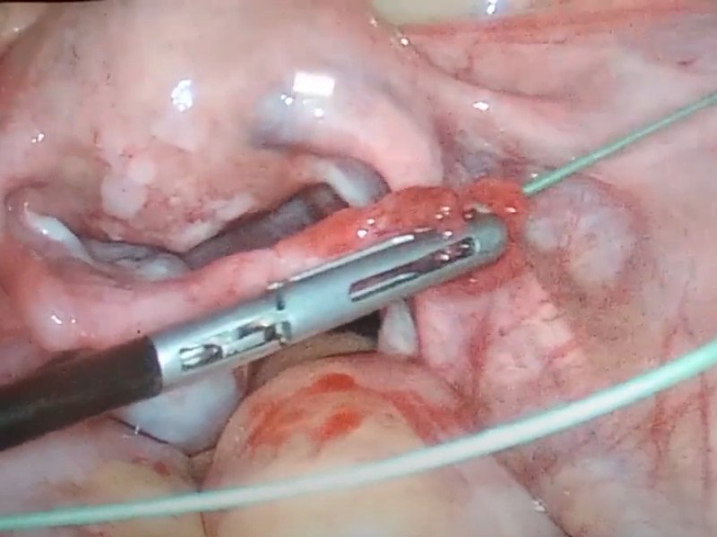 Tubal Cannulization Surgery