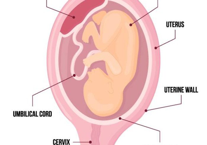 Treatment of Placenta Accreta in Lahore Pakistan