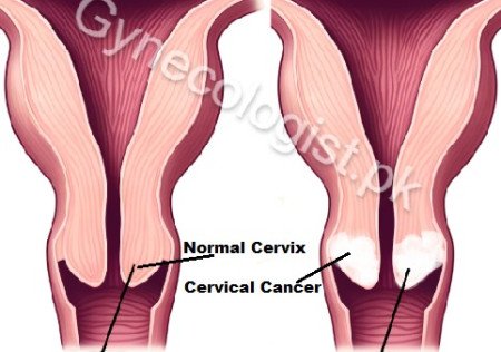 Cervical Cancer treatment in Lahore Pakistan