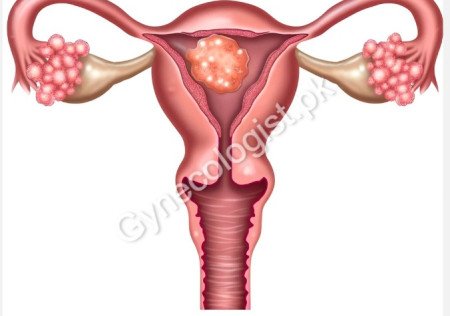 Ovarian Cancer Treatment in Lahore Pakistan