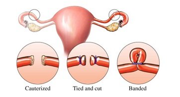 Tubal Anastomosis