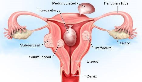 Abdominal hysterectomy