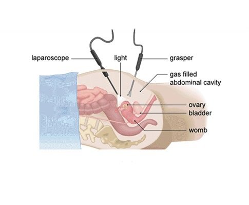 Laparoscopic Procedures