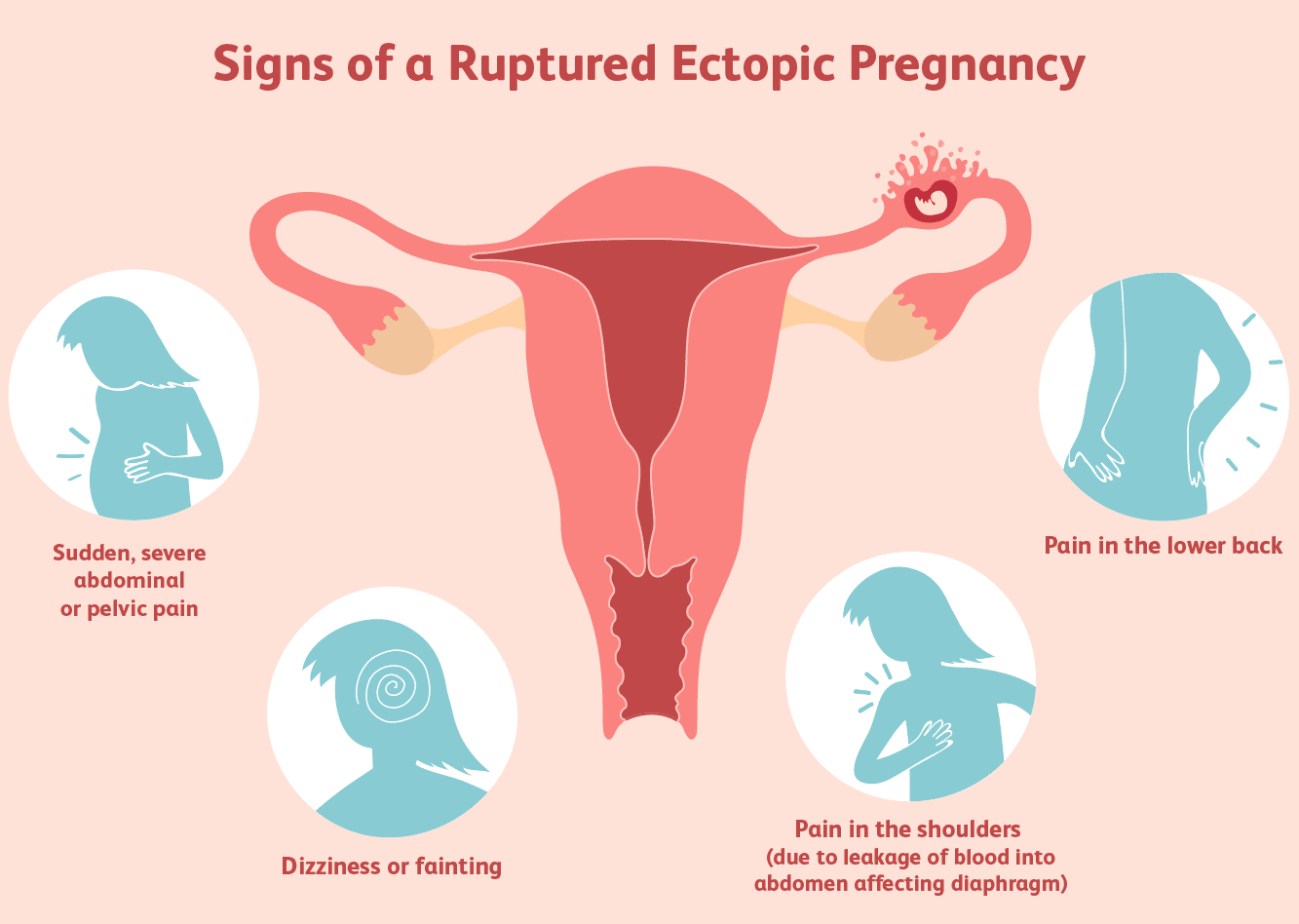 ECTOPIC PREGNANCY TREATMENTS