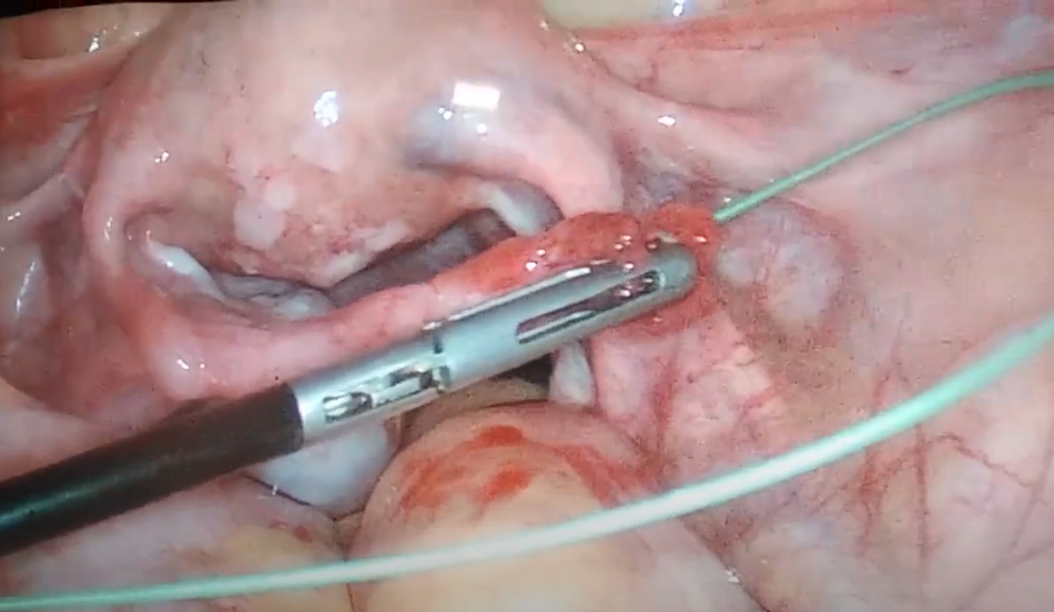 Blocked fallopian tube opening